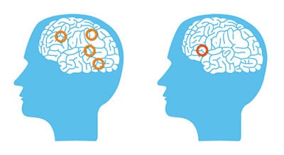 Cerveau normal vs cerveau dyslexique - Les Neurones de la Lecture