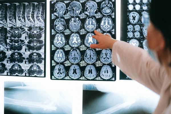 Suis-je hypersensible: imagerie médicale hypersensibilité et cerveau humain